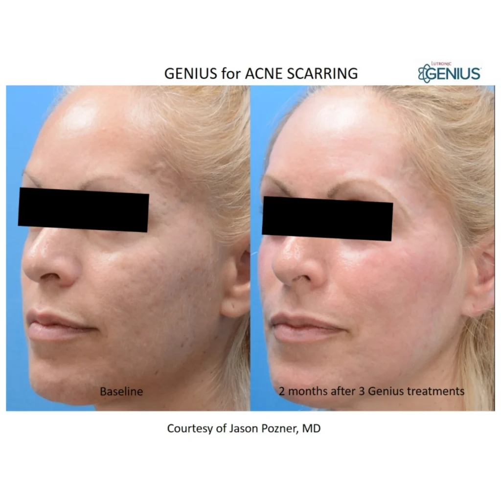 Genius® RF Microneedling Park City